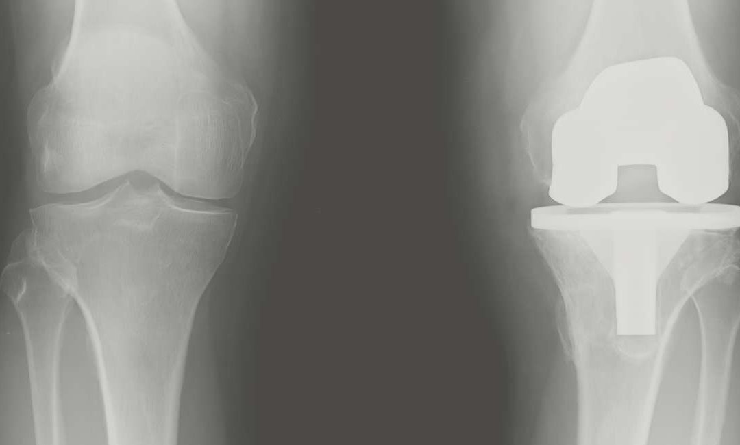 Rehabilitación de la Prótesis de Rodilla: Un Enfoque de Fisioterapia Avanzada