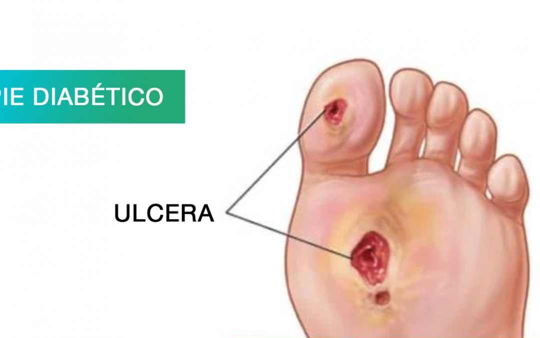 La nutrición con diabetes y las heridas crónicas del pie diabético