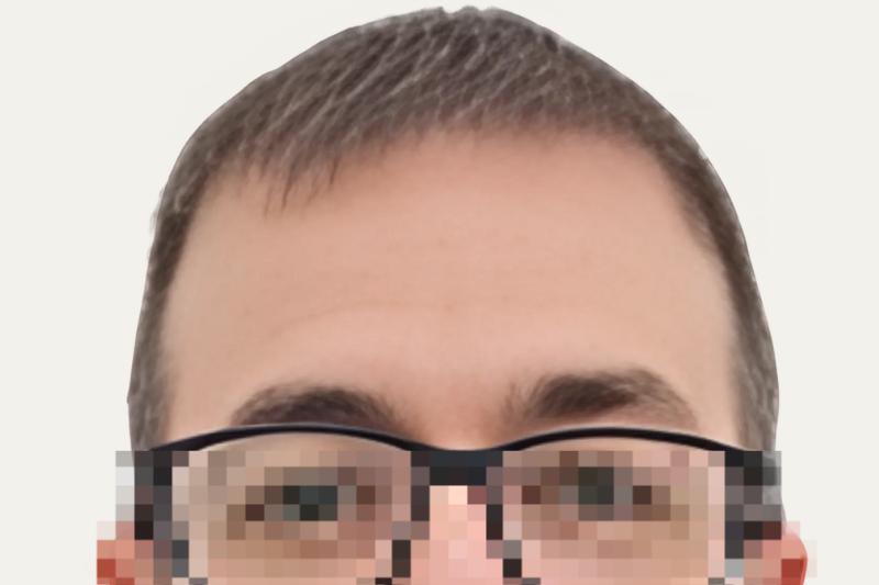 Tras 5 meses Sin trasplante capilar