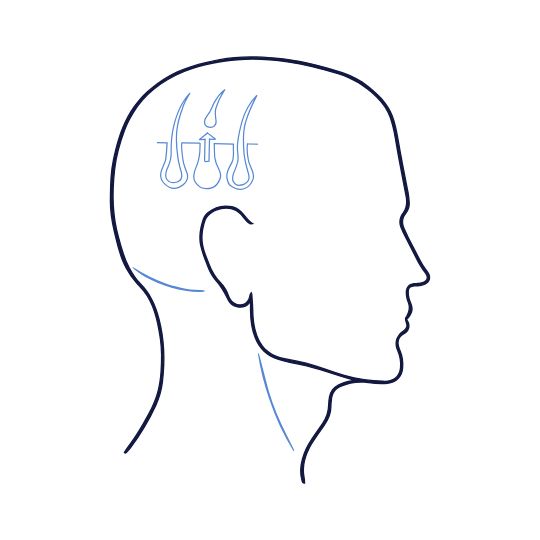 Transplante capilar Viten