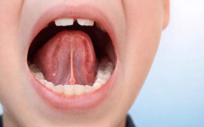 Frenillo y su impacto en el desarrollo del habla y la alimentación