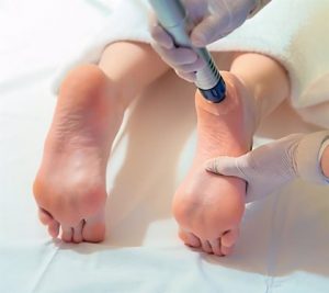 fascitis plantar