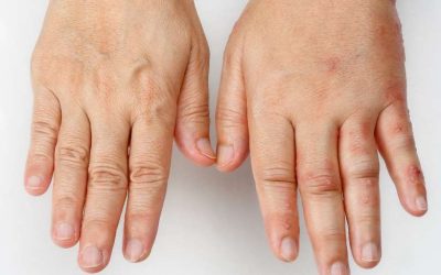 Diferencias entre el síndrome de Haglund y el síndrome de Sudeck