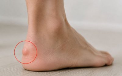Enfermedad de Haglund y su tratamiento de fisioterapia