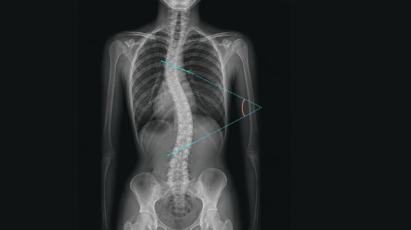 Escoliosis idiopática Viten
