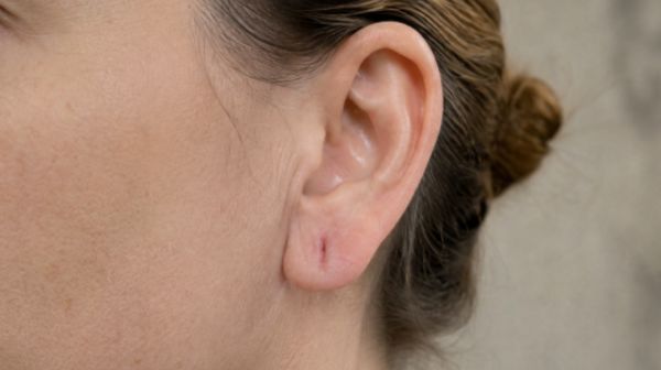 Lobuloplastia Málaga