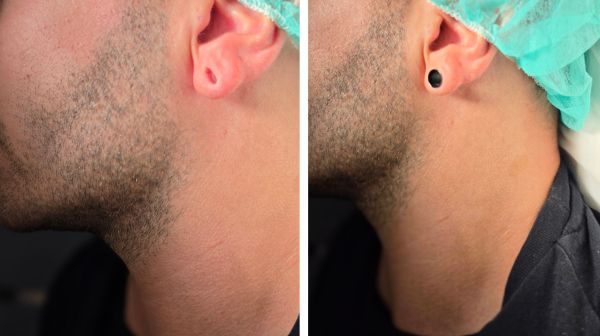 Lobuloplastia Málaga