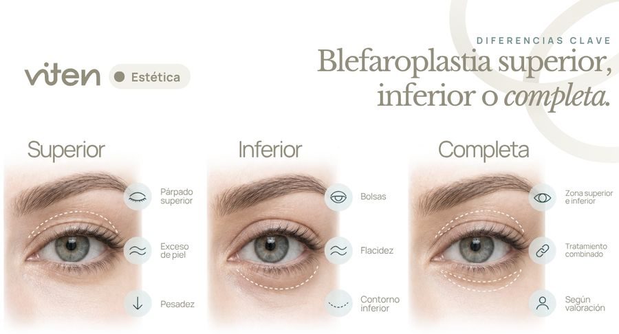 Blefaroplastia superior e inferior Málaga